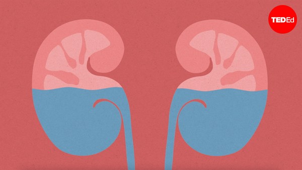 Arash Shadman: What causes kidney stones?